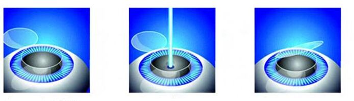 Phase of the correction of laser vision