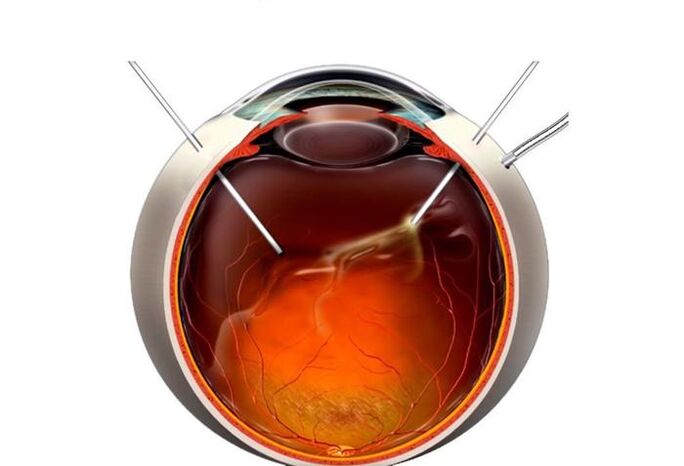 Vitrenctomy an operation to restore vision